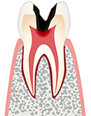 歯髄（神経）まで到達した虫歯
